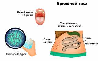 Паратифы: что это за болезнь и как ее распознать?