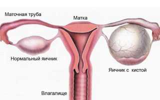Киста яичника у девочек подростков