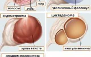 Осложнения кисты яичника и последствия заболевания