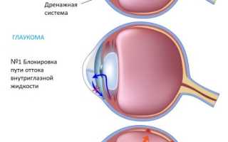 Офтальмогипертензия: что это такое и как с ней бороться