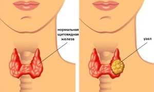 Причины узлового зоба щитовидной железы