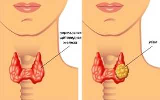 Причины узлового зоба щитовидной железы