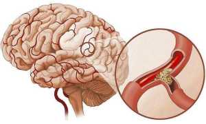 Что делать, если забиты сосуды головного мозга