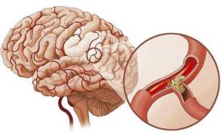 Что делать, если забиты сосуды головного мозга