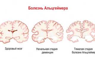 Что такое легкое когнитивное расстройство и как с ним справиться