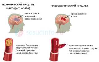 Стеноз вен головного мозга