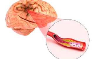 Признаки и лечение церебрального атеросклероза сосудов головного мозга