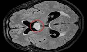 Киста Верге головного мозга: что это такое, диагностика, лечение