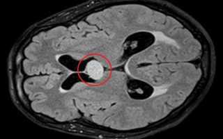 Киста Верге головного мозга: что это такое, диагностика, лечение