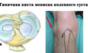 Виды и причины развития кисты коленного сустава
