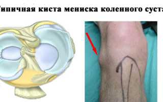 Виды и причины развития кисты коленного сустава