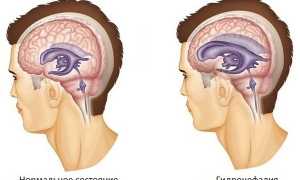 Заместительная гидроцефалия: симптомы, диагностика, лечение