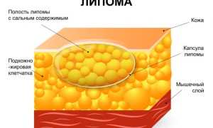 Как лечить липому и что это такое
