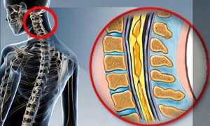 Сирингомиелия: что это за болезнь, признаки, диагностика, лечение