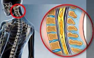 Сирингомиелия: что это за болезнь, признаки, диагностика, лечение