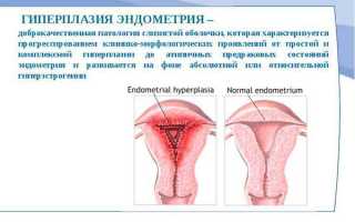 Лечение железистой гиперплазии эндометрия