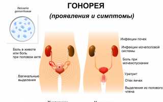 Как распознать гонорею у женщин — основные симптомы