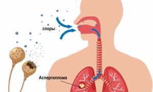 Аспергиллез: что это такое простыми словами