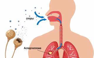 Аспергиллез: что это такое простыми словами