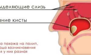 Кисты верхнечелюстной пазухи ее причины и лечение