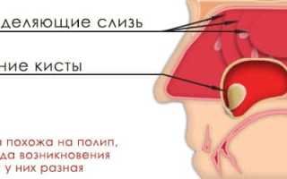Кисты верхнечелюстной пазухи ее причины и лечение