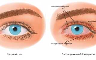 Что такое блефароконъюнктивит: причины, симптомы и лечение