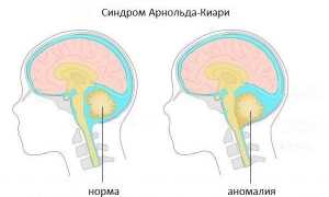 Мальформация Арнольда-Киари: признаки, лечение, последствия