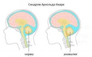 Мальформация Арнольда-Киари: признаки, лечение, последствия