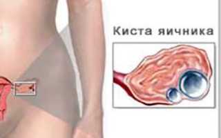 Могут ли рассосаться кисты яичников