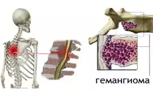 Что такое гемангиома на позвоночнике и как с ней бороться