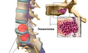 Что такое гемангиома позвоночника поясничного отдела? Разбираемся подробно