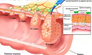 Карцинома ободочной кишки: что это и как с этим жить?