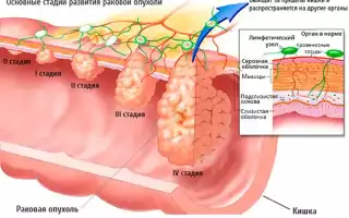 Карцинома ободочной кишки: что это и как с этим жить?