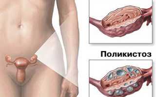Все о поликистозе яичников