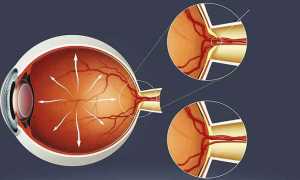 Офтальмогипертензия: что это такое и как ее лечить у взрослых?