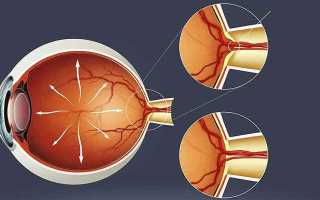Офтальмогипертензия: что это такое и как ее лечить у взрослых?