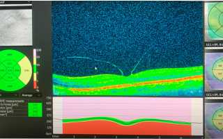 Что такое эрм в офтальмологии и как он может изменить вашу жизнь