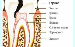 Как определить кисту зуба на рентгеновском снимке