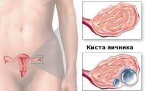 Особенности лечения кисты яичника пиявками
