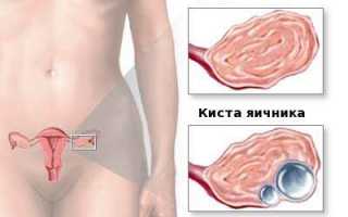 Особенности лечения кисты яичника пиявками
