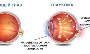 Закрытоугольная глаукома: что это и какие у нее симптомы