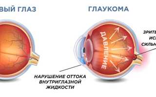 Закрытоугольная глаукома: что это и какие у нее симптомы