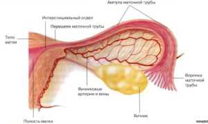 Симптомы и лечение кисты маточной трубы