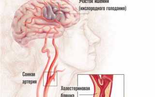 Признаки острого нарушения мозгового кровообращения