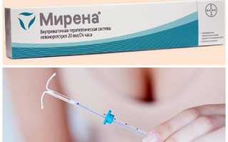 Мирена и эндометриоз — правда от женщин
