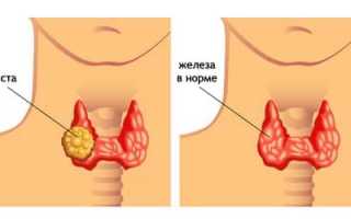 Все о кисте щитовидной железы
