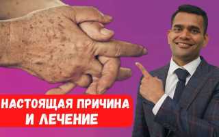 Рыжие пятна — причины появления и способы лечения