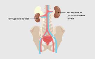 Что такое нефроз почек простыми словами
