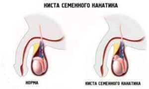 Симптомы и лечение кисты семенного канатика