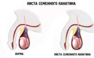 Симптомы и лечение кисты семенного канатика